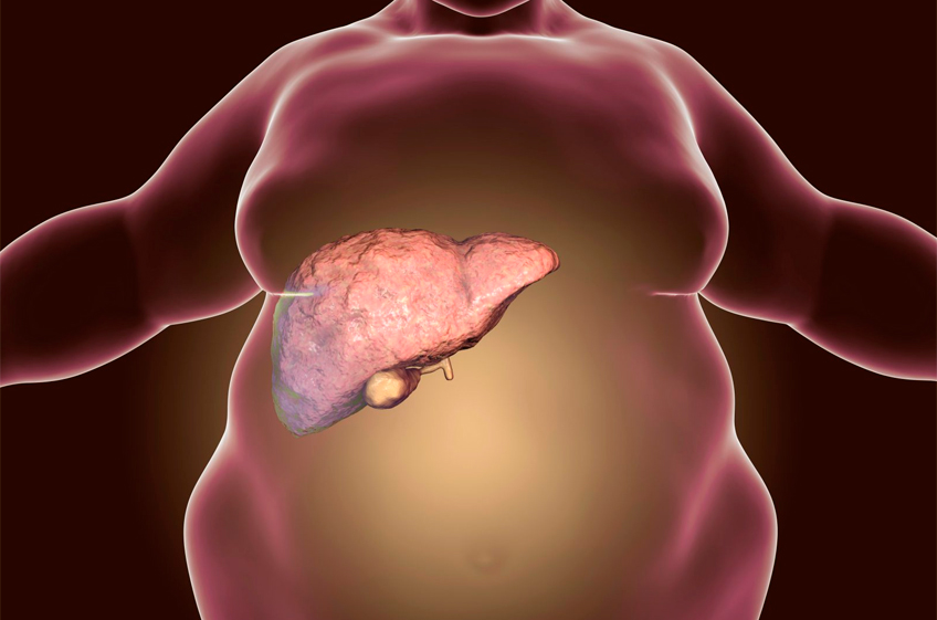 Что нужно знать о жировом гепатозе печени